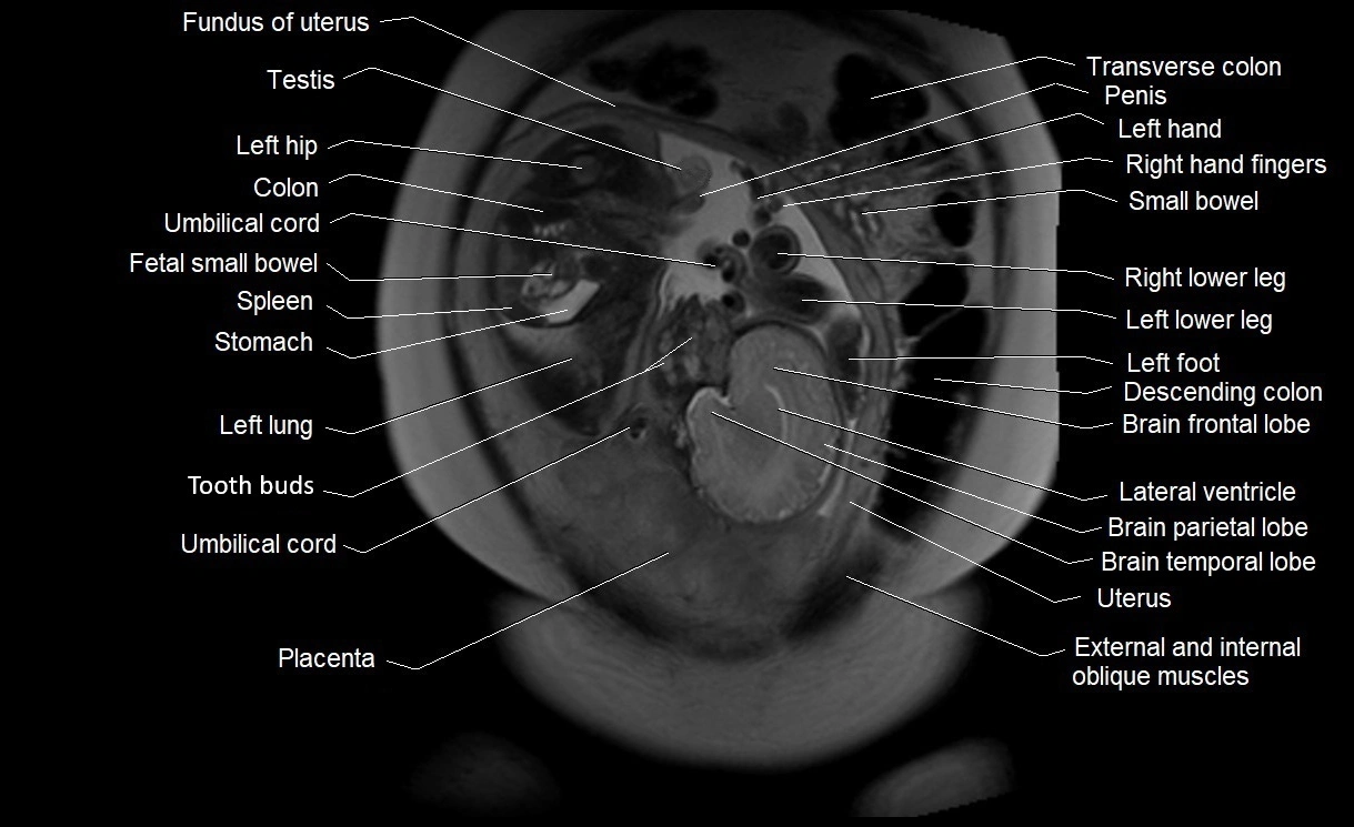 MRI Anatomy of pregnancy image 9.webp